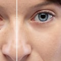 5 semplici passaggi per rimuovere la crema antirughe intorno agli occhi