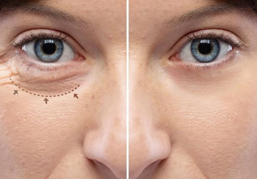 5 semplici passaggi per rimuovere la crema antirughe intorno agli occhi